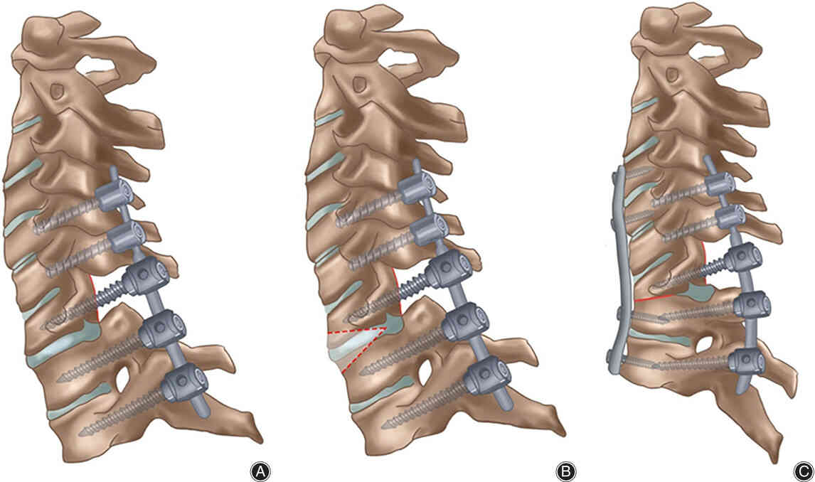 Spine Surgery Meaning Types And Risk Factors