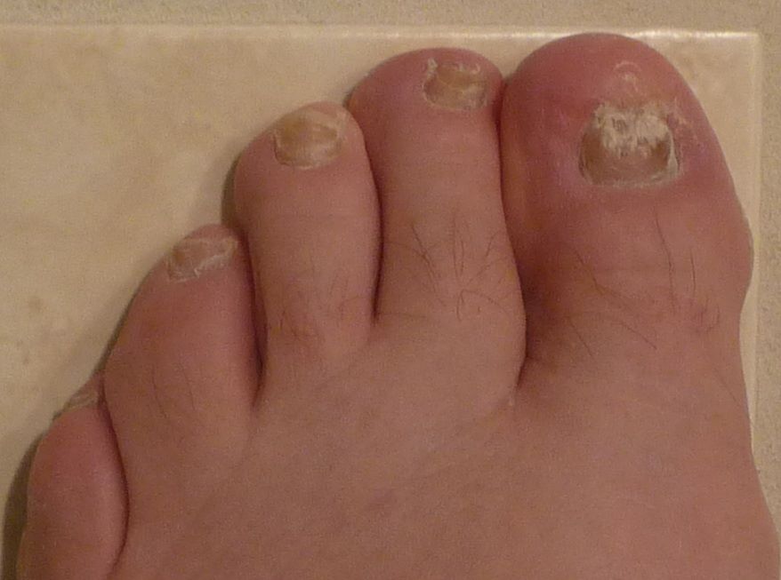 Onychomycosis