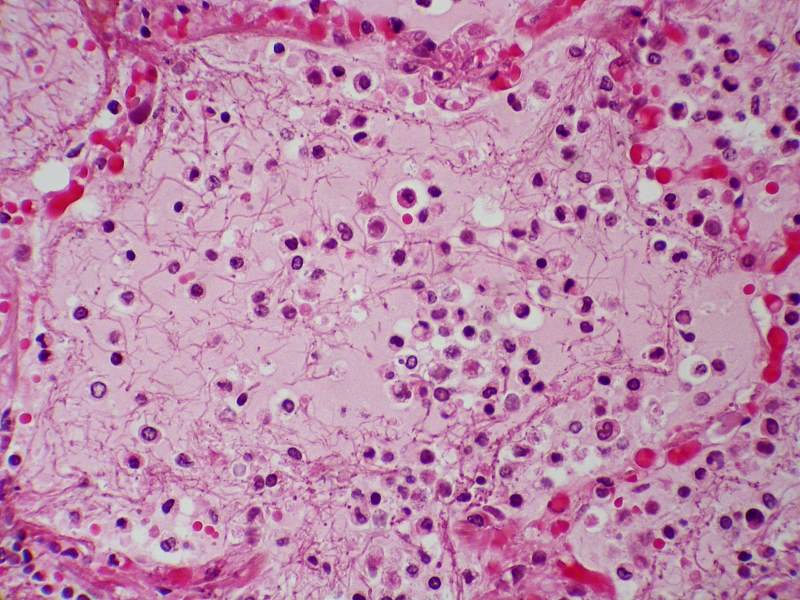 bacterial-pneumonia