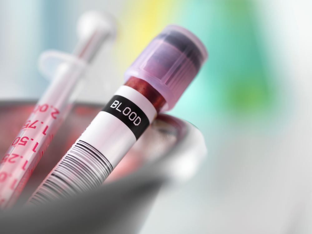 blood-sample-taken-for-analysis-with-needle