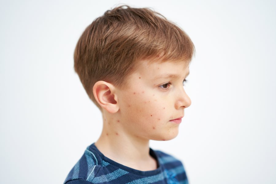 what are the causes and symptoms of chicken pox