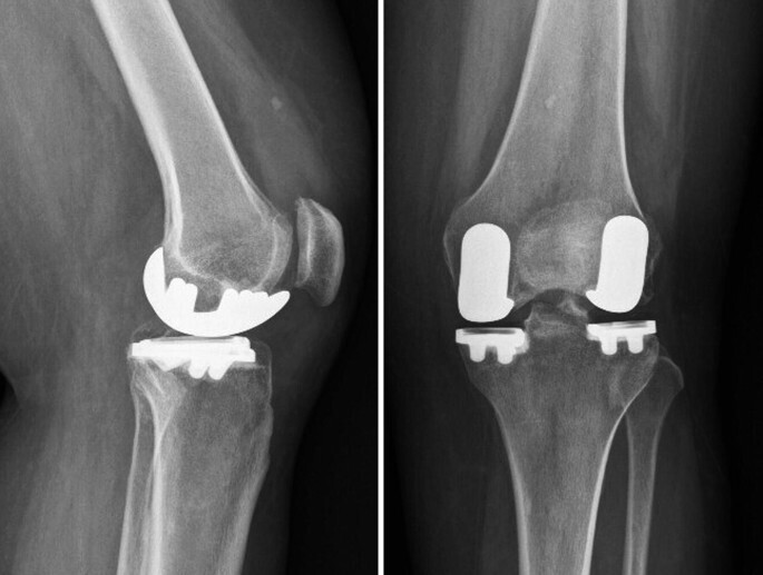 What is Knee Replacement? - Types , What to Expect & Cost of Surgery