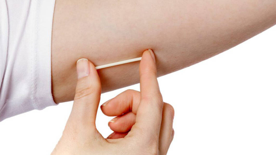 birth control implant