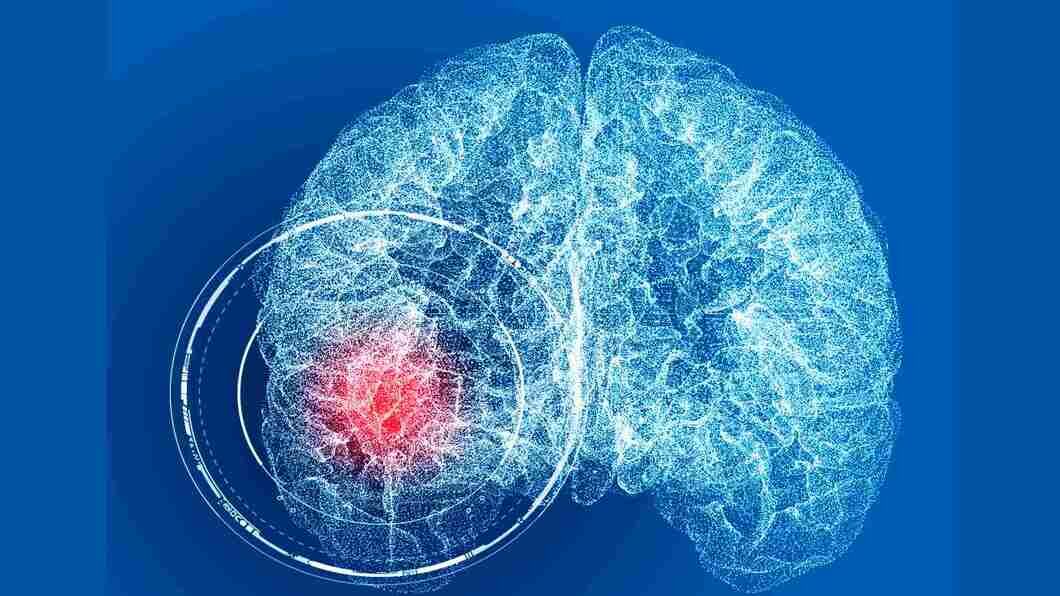 What Is Brain Cerebral Aneurysm Symptoms Causes Treatment 7900