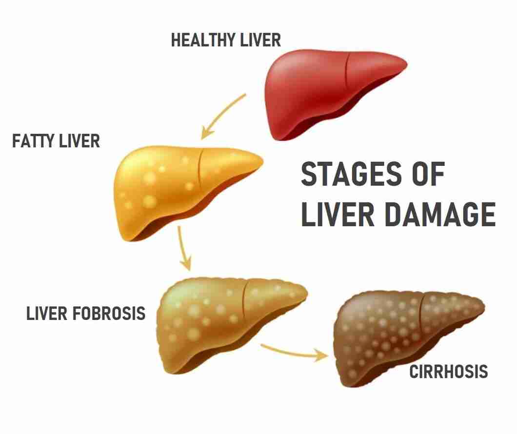 Liver Cirrhosis: Symptoms, Causes, Stages, Treatment & Prevention