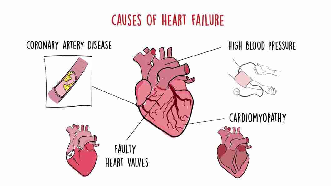 Congestive Heart Failure: Symptoms, Causes, Types, Treatment & Prevention