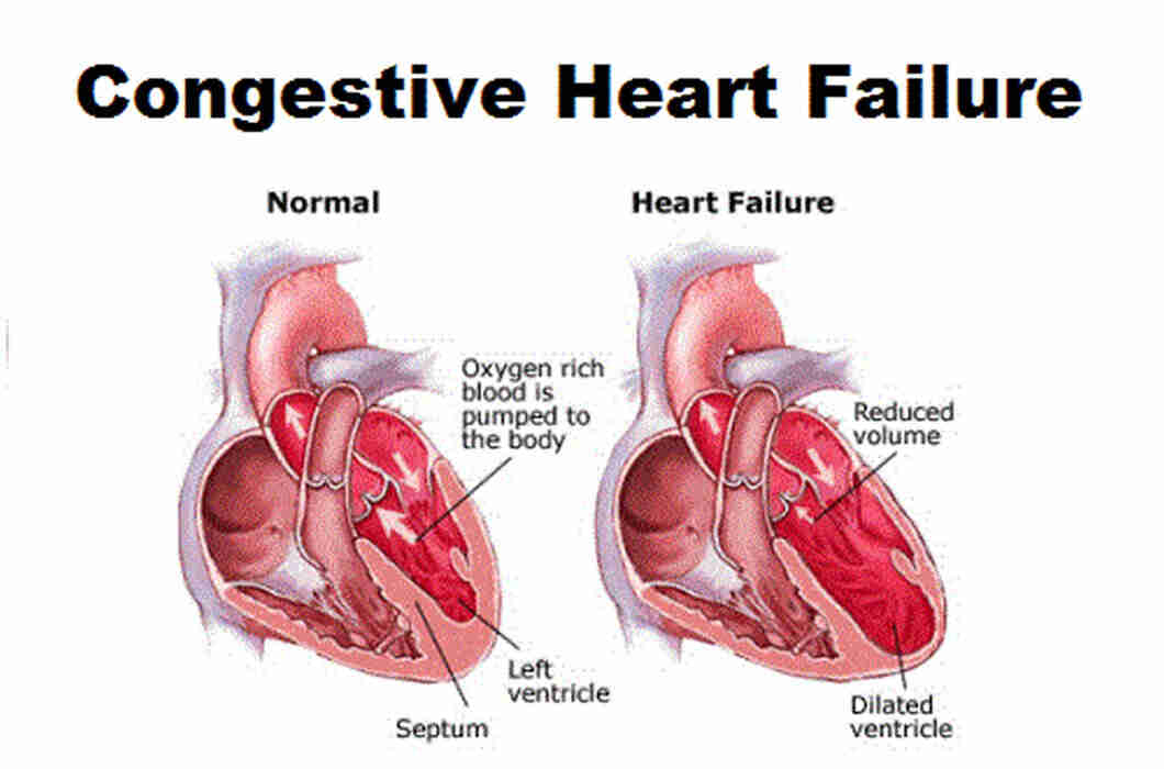 congestive heart failure patient