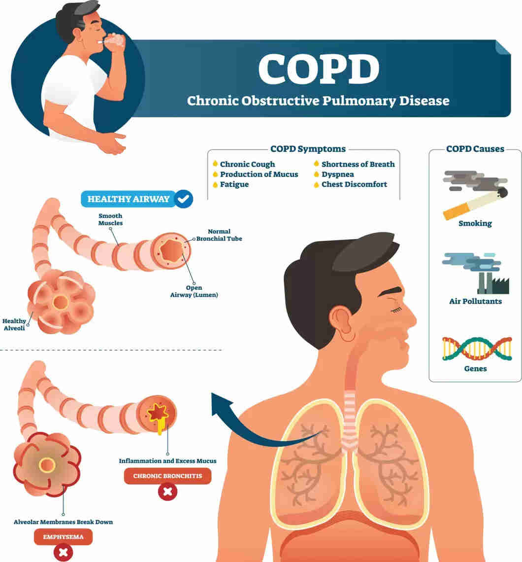 COPD Symptoms Causes Types Treatment Prevention