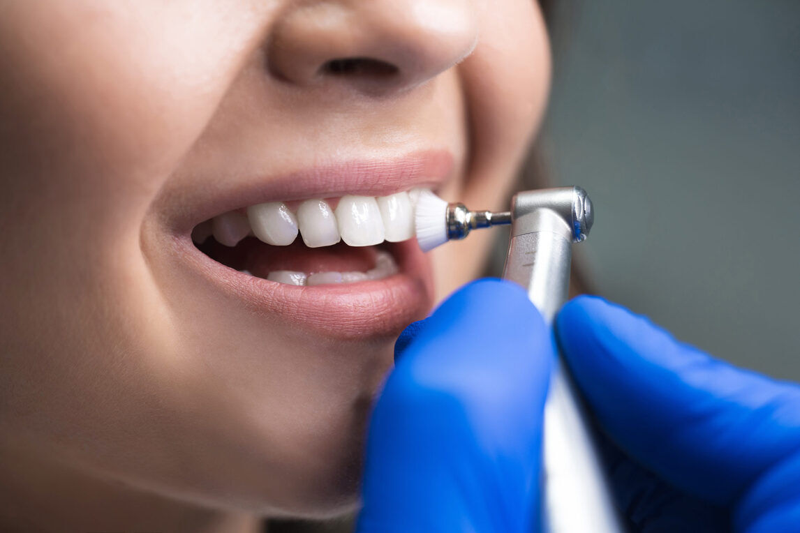 Know Everything About Different Types of Dental Cleaning