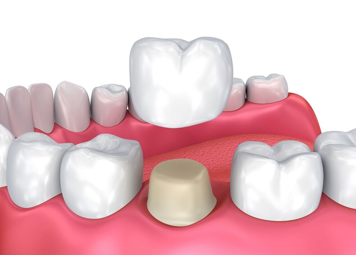 What Are Dental Crown and Bridges?