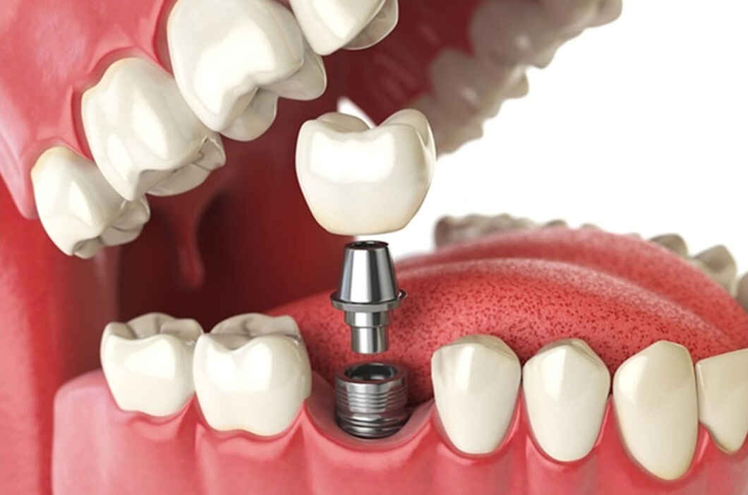 Dental Implants Meaning & Types