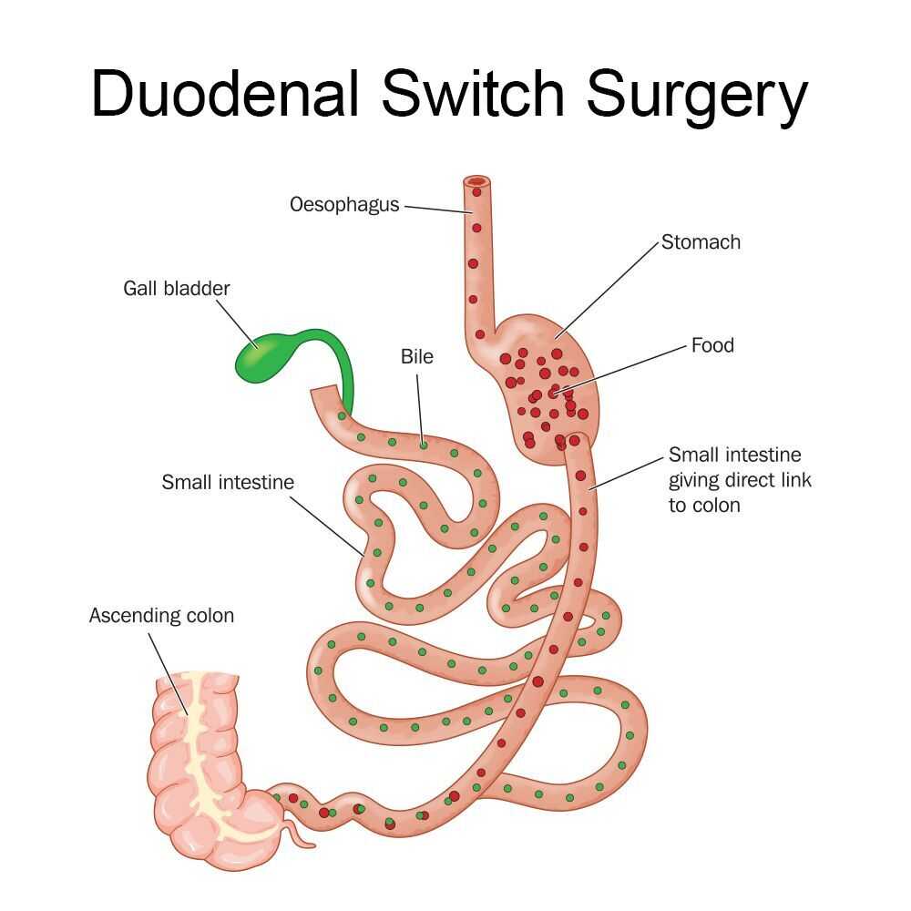 duodenal switch surgery