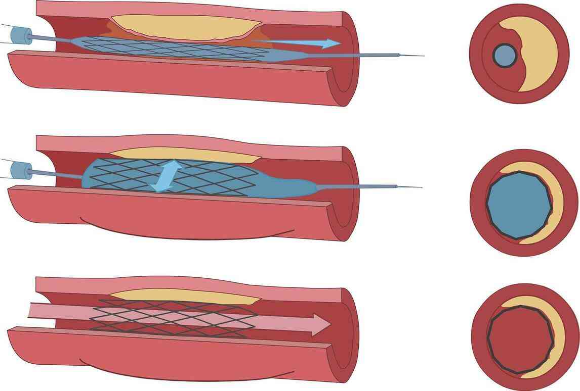 Atherectomy Surgery: Types & Risks of an Atherectomy