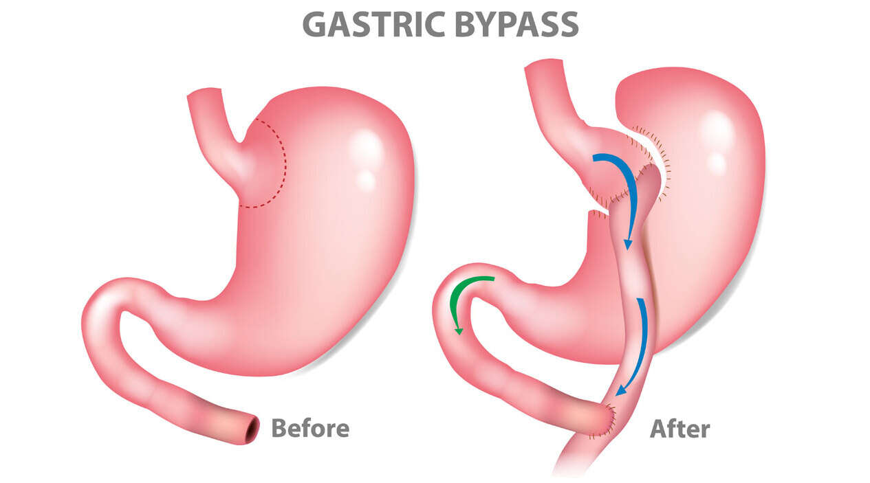 gastric bypass surgery