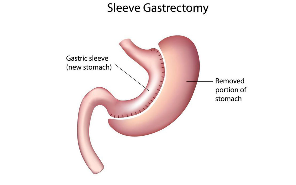 gastric sleeve surgery