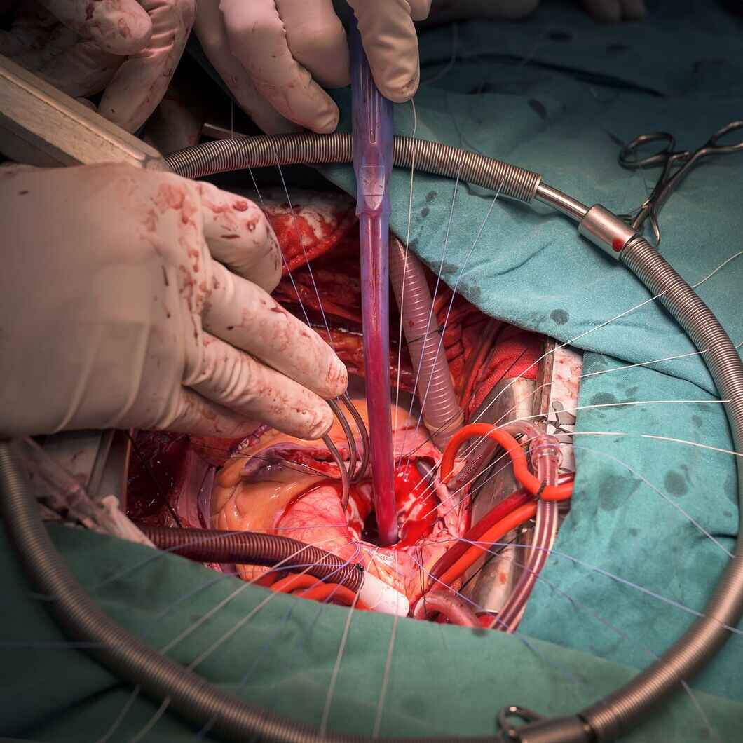 cardiac surgery