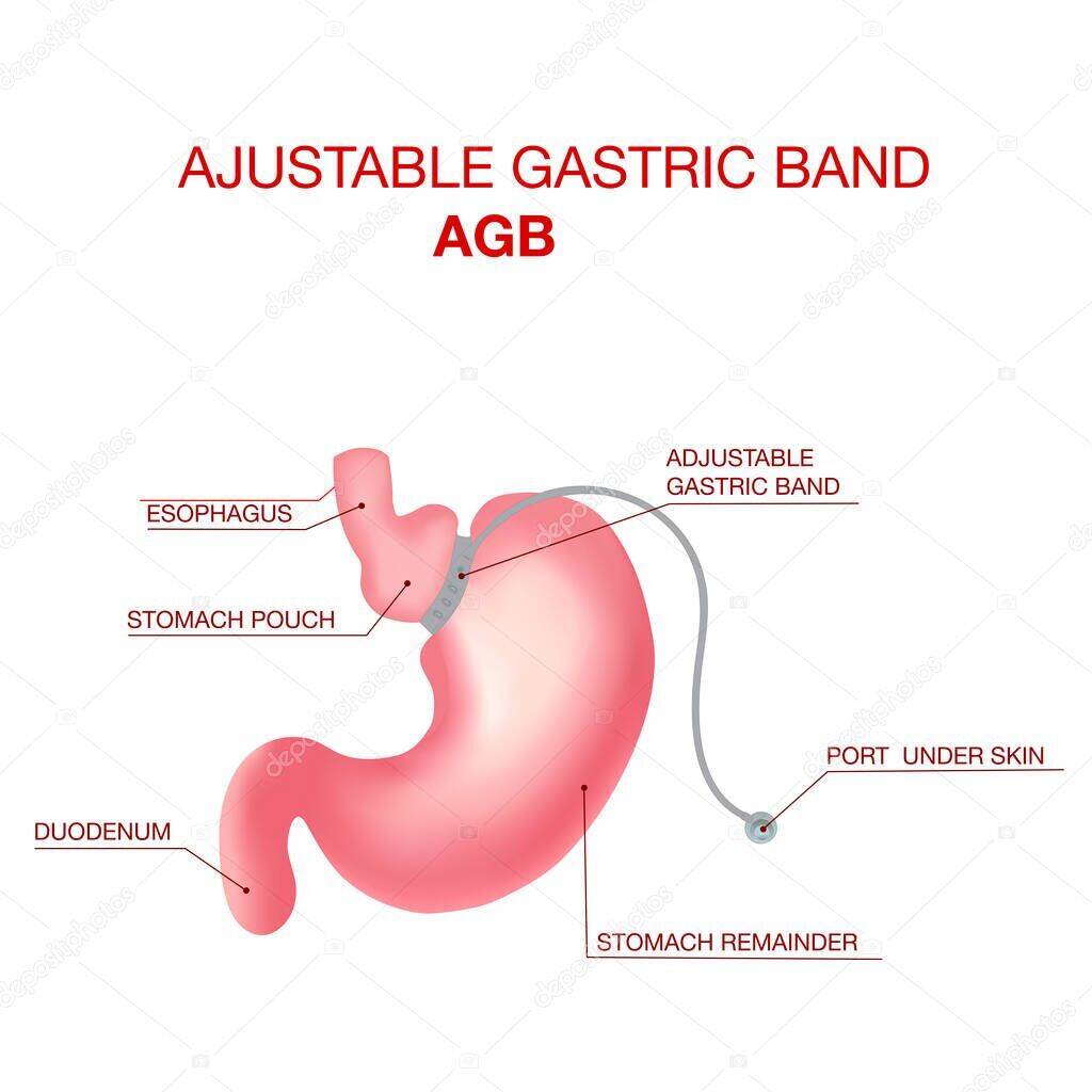 laparoscopic adjustable gastric banding