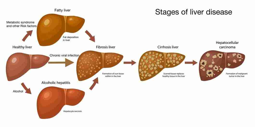 Liver Cirrhosis Stages Causes And Symptoms Star Health Sexiz Pix