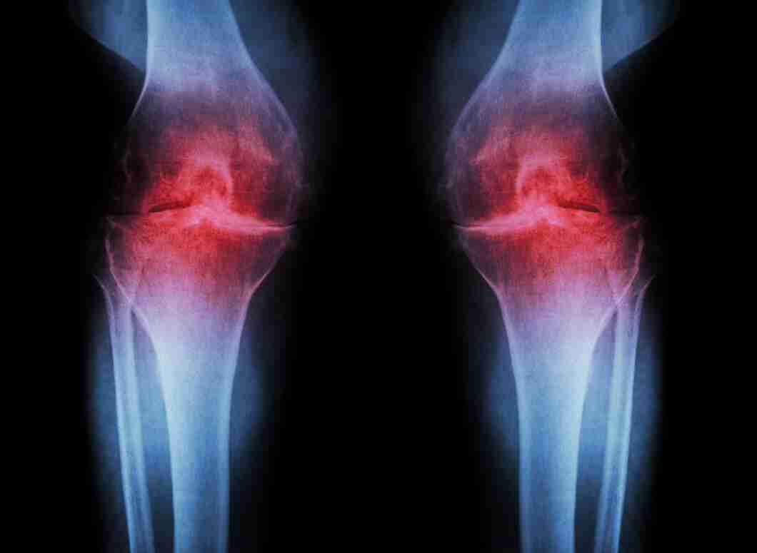 Arthritis in Knee - Diagnosis, Treatment and Prevention