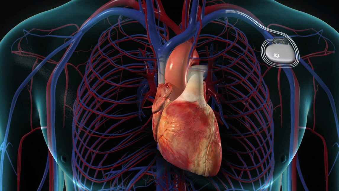 what-is-pacemaker-surgery-meaning-and-different-types