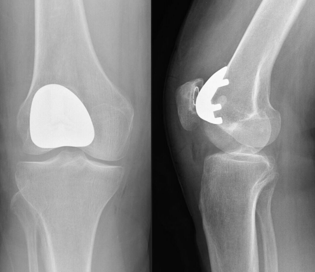 What is Knee Replacement? - Types , What to Expect & Cost of Surgery