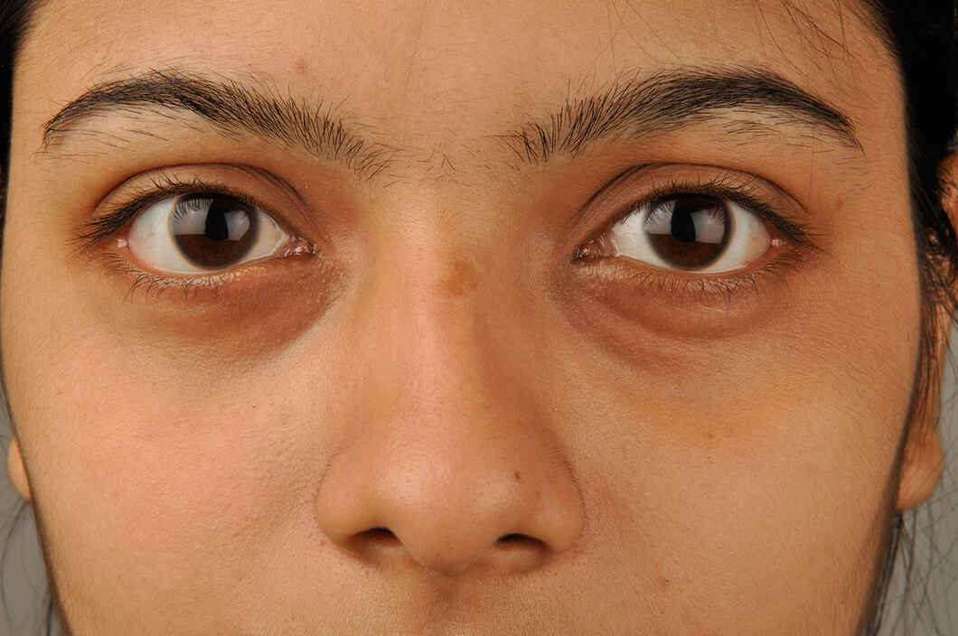 Puffy Eyes Meaning Symptoms Causes Treatments