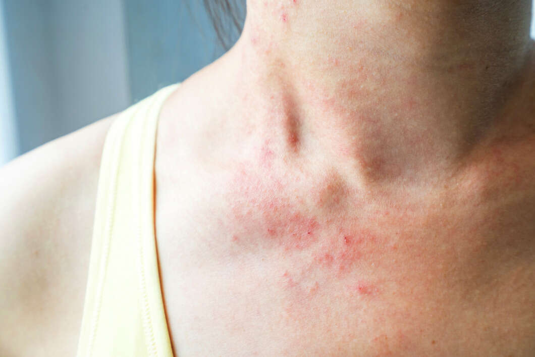 Skin Rashes Symptoms Causes Types Prevention And Treatment