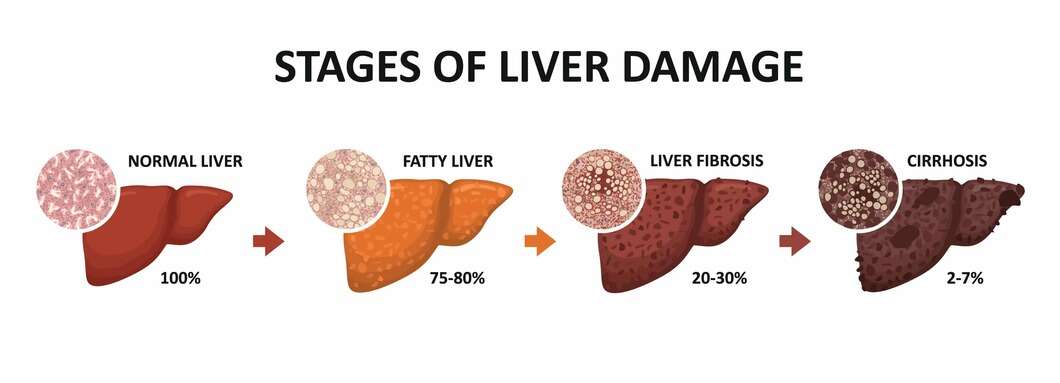 Alcohol-Related Liver Disease: Types & Treatments