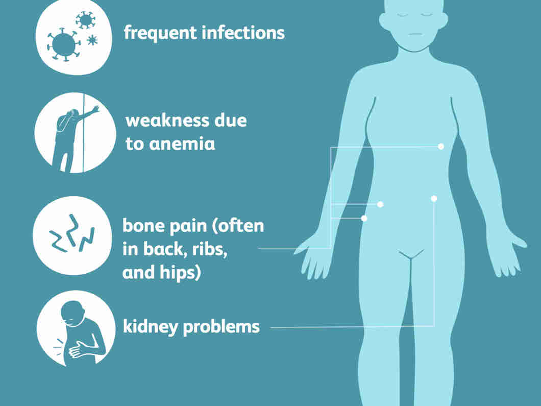 Bone Marrow Cancer Types Symptoms And Treatment