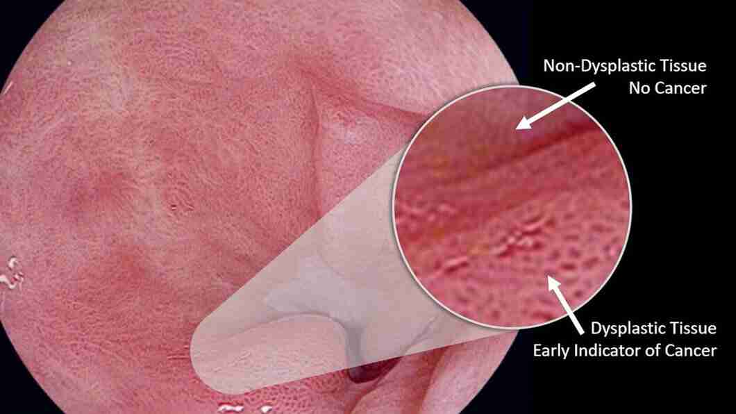 symptoms of oesophageal cancer