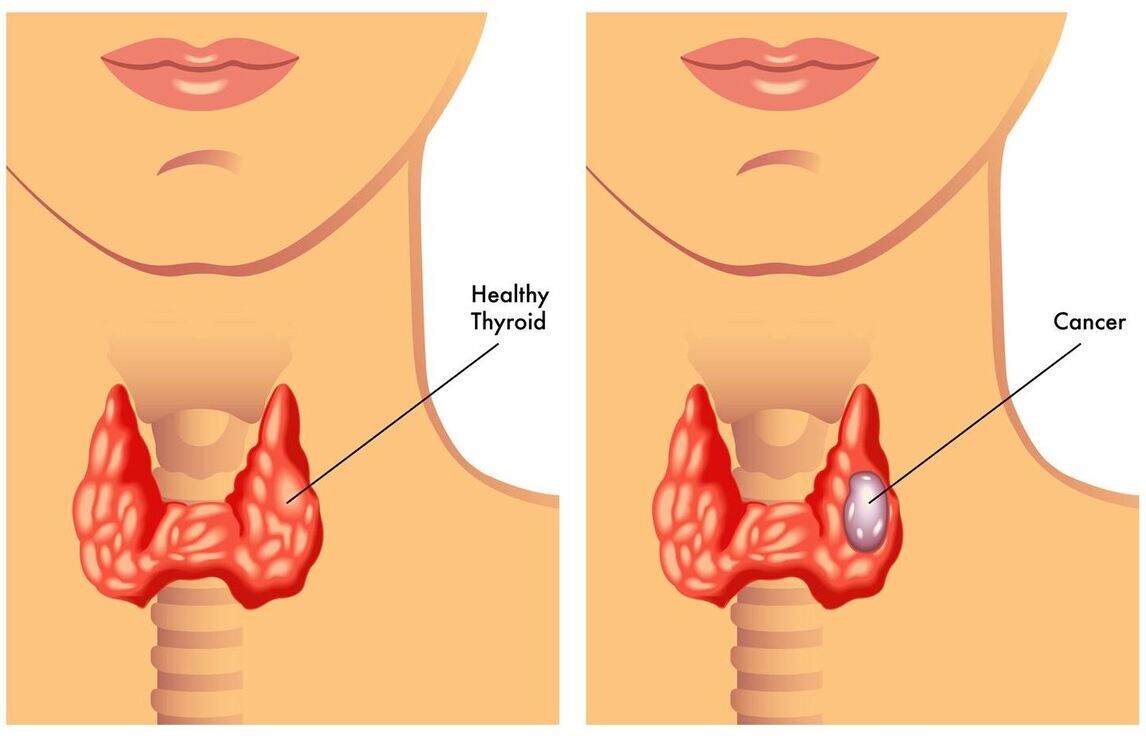 Adenocarcinoma Cancers: Symptoms, Causes, Diagnosis & Treatment