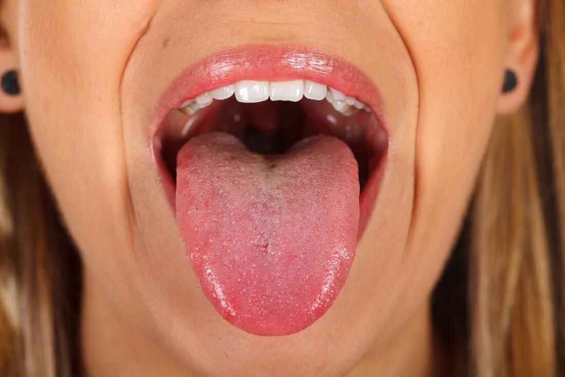 Tongue Cancer Causes Types Symptoms Diagnosis And Treatment