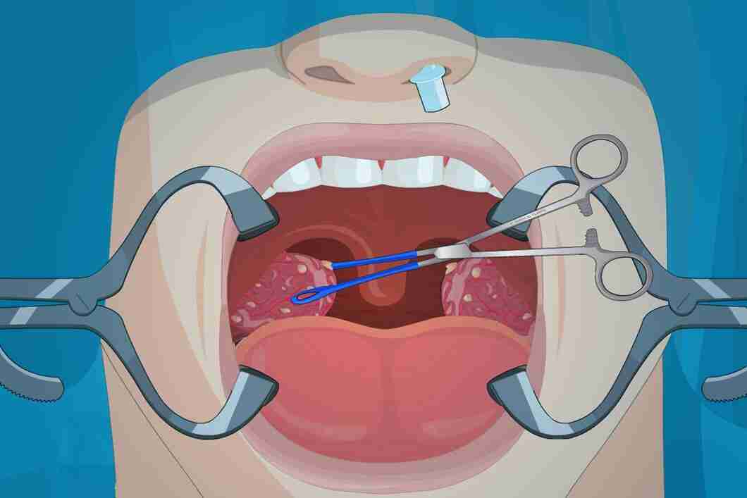 tonsillitis-symptoms-causes-and-treatment