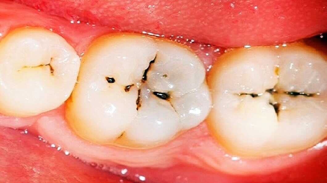 Tooth Cavity Treatment
