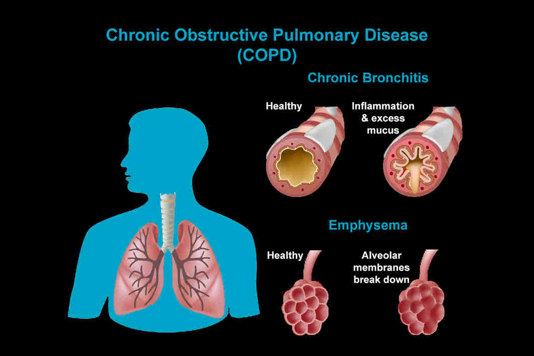 COPD Symptoms, Causes, Types, Treatment & Prevention