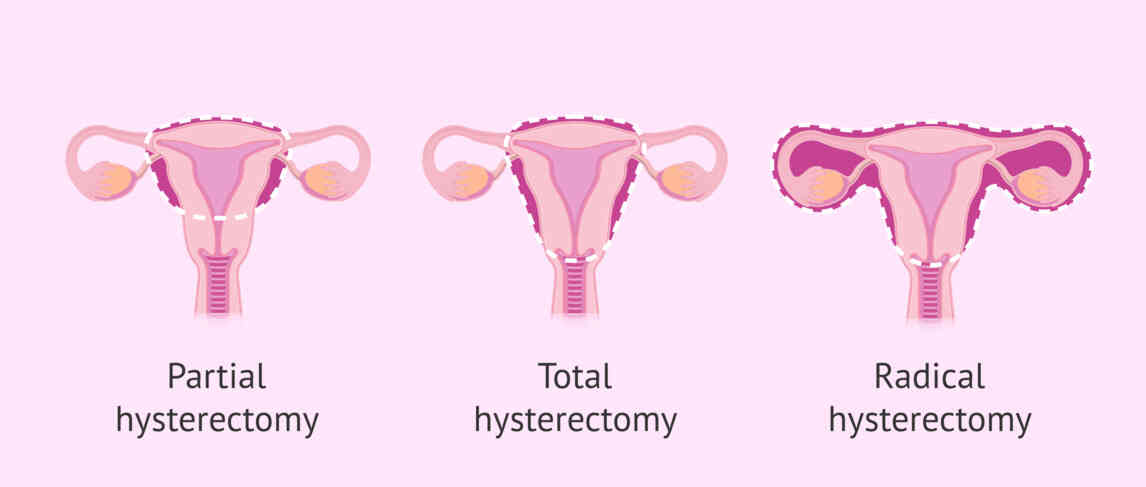 what-is-hysterectomy-hysterectomy-types-procedure-risks-recovery