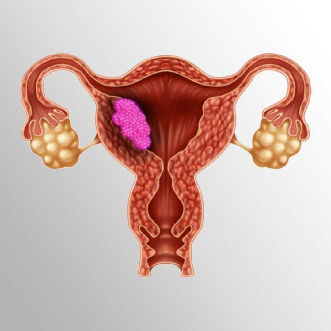 Uterine Cancer Symptoms Causes Diagnosis Treatment Prevention