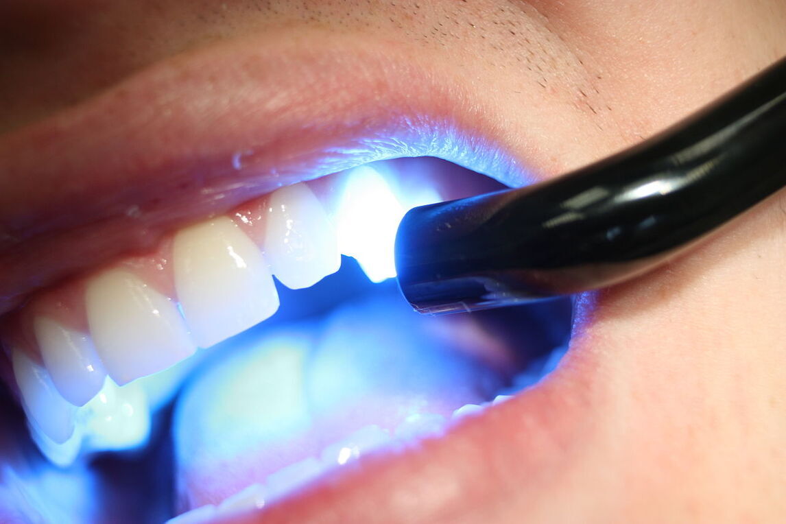 Is UV Light Teeth Whitening Safe?