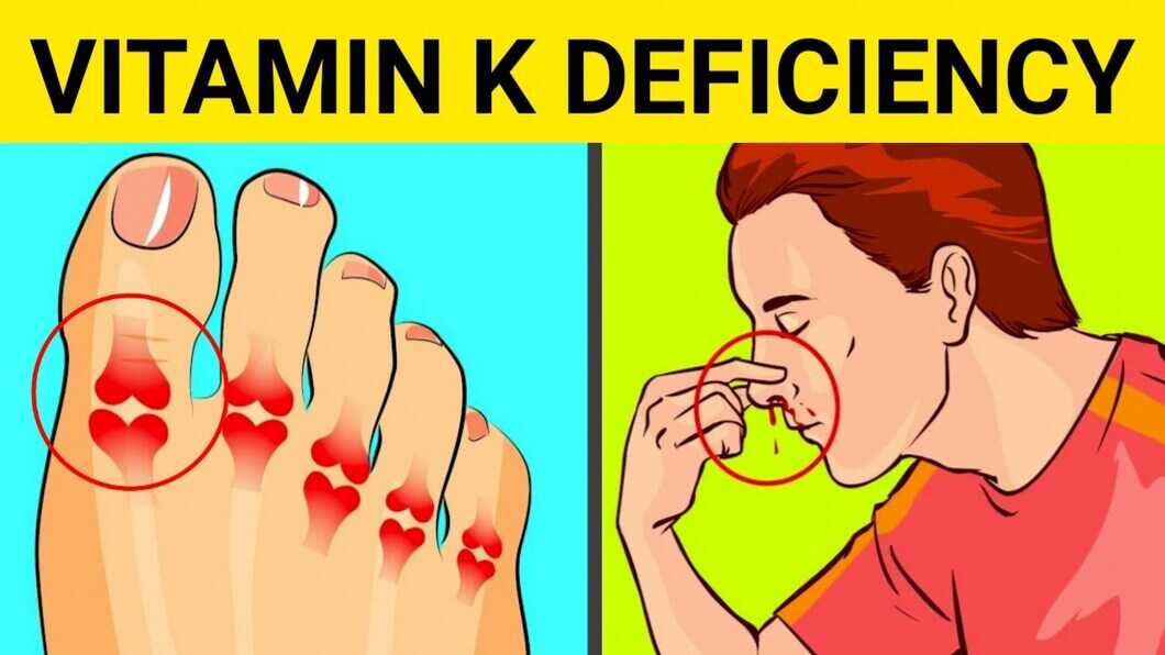 Vitamin K Deficiency Symptoms Causes Treatment Prevention