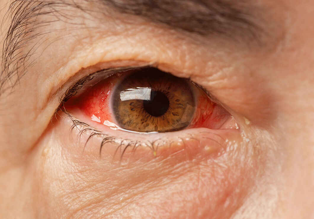 Everything You Need To Know About Glaucoma