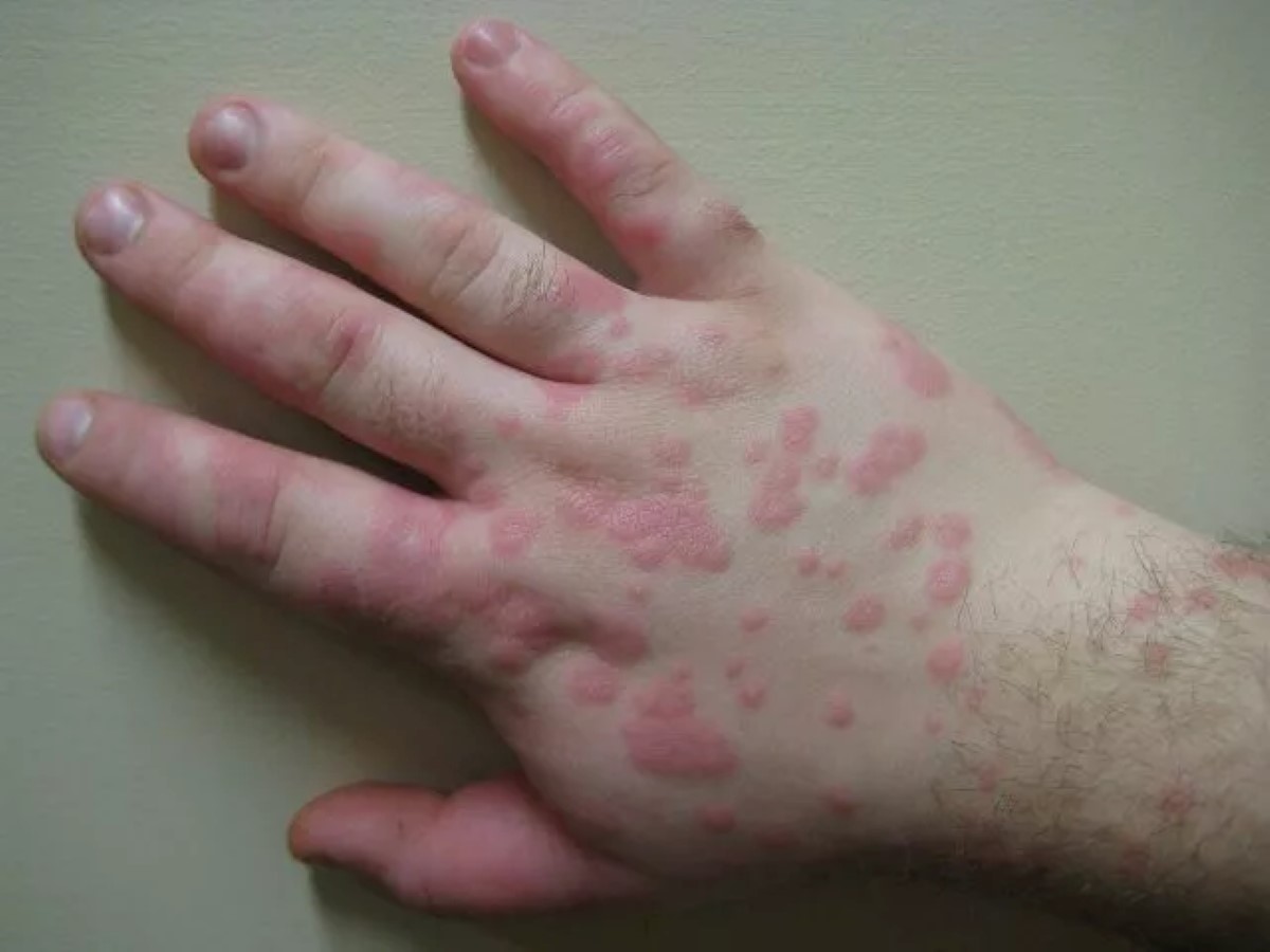 erythema nodosum