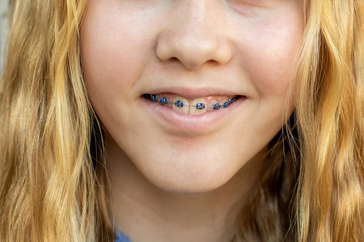 A young girl wearing a traditional metal braces in teeth