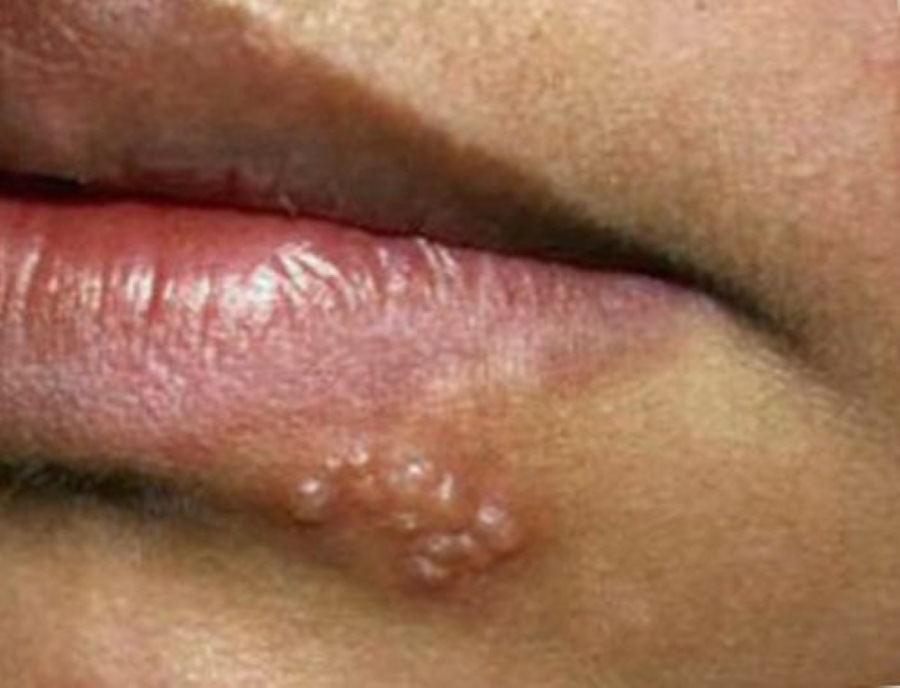 herpes simplex throat allergy