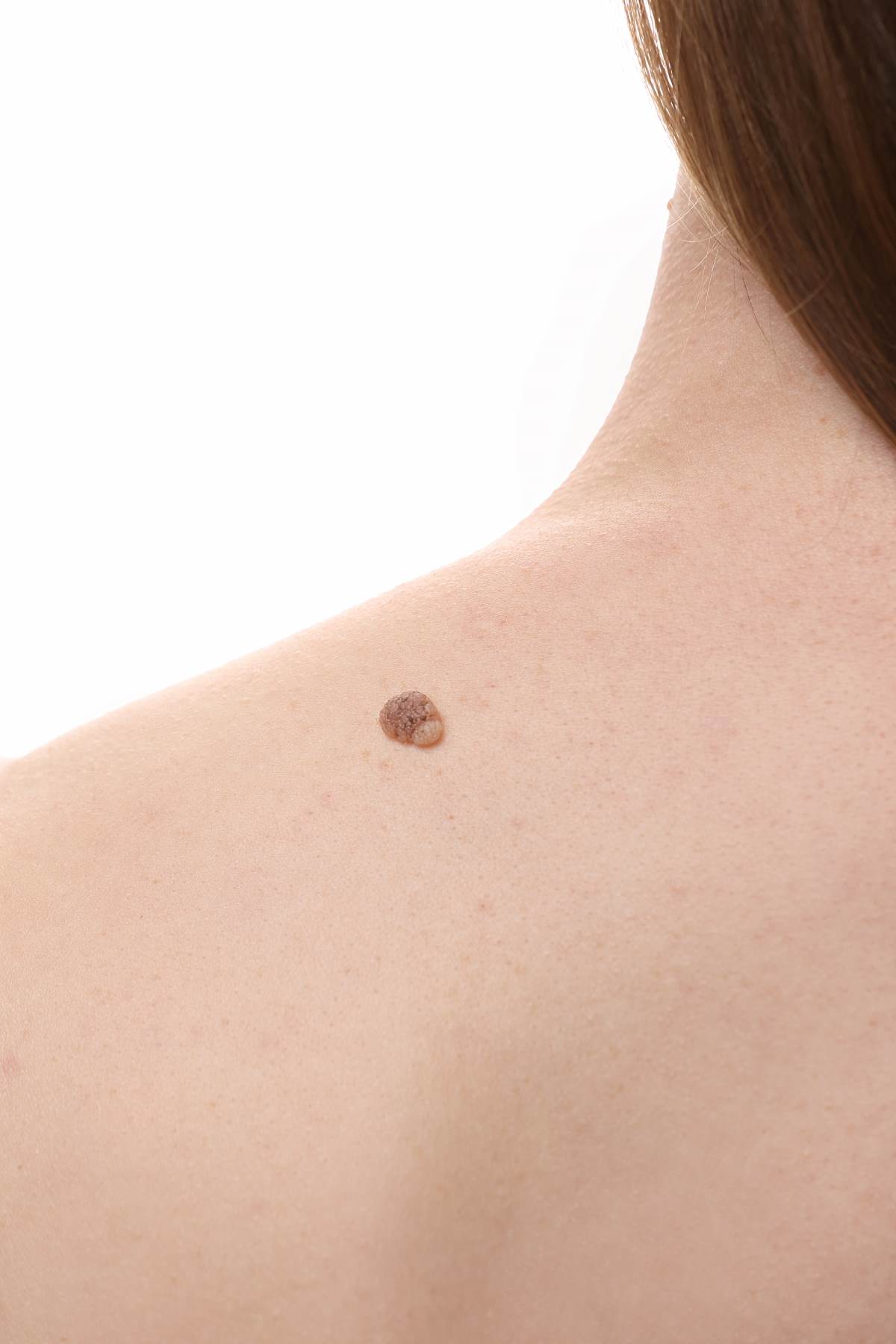 large warts on female shoulder