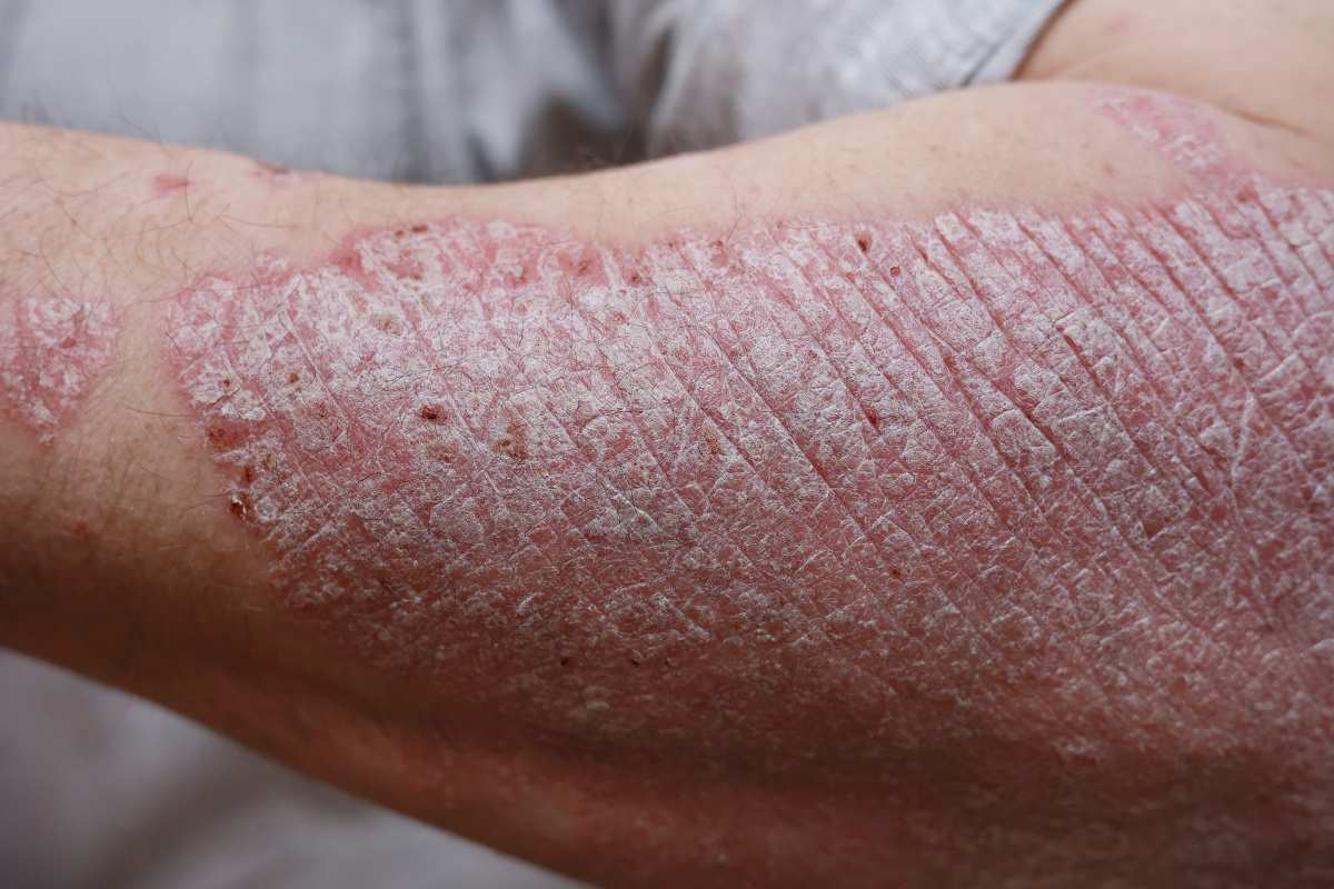 macro of psoriasis skin