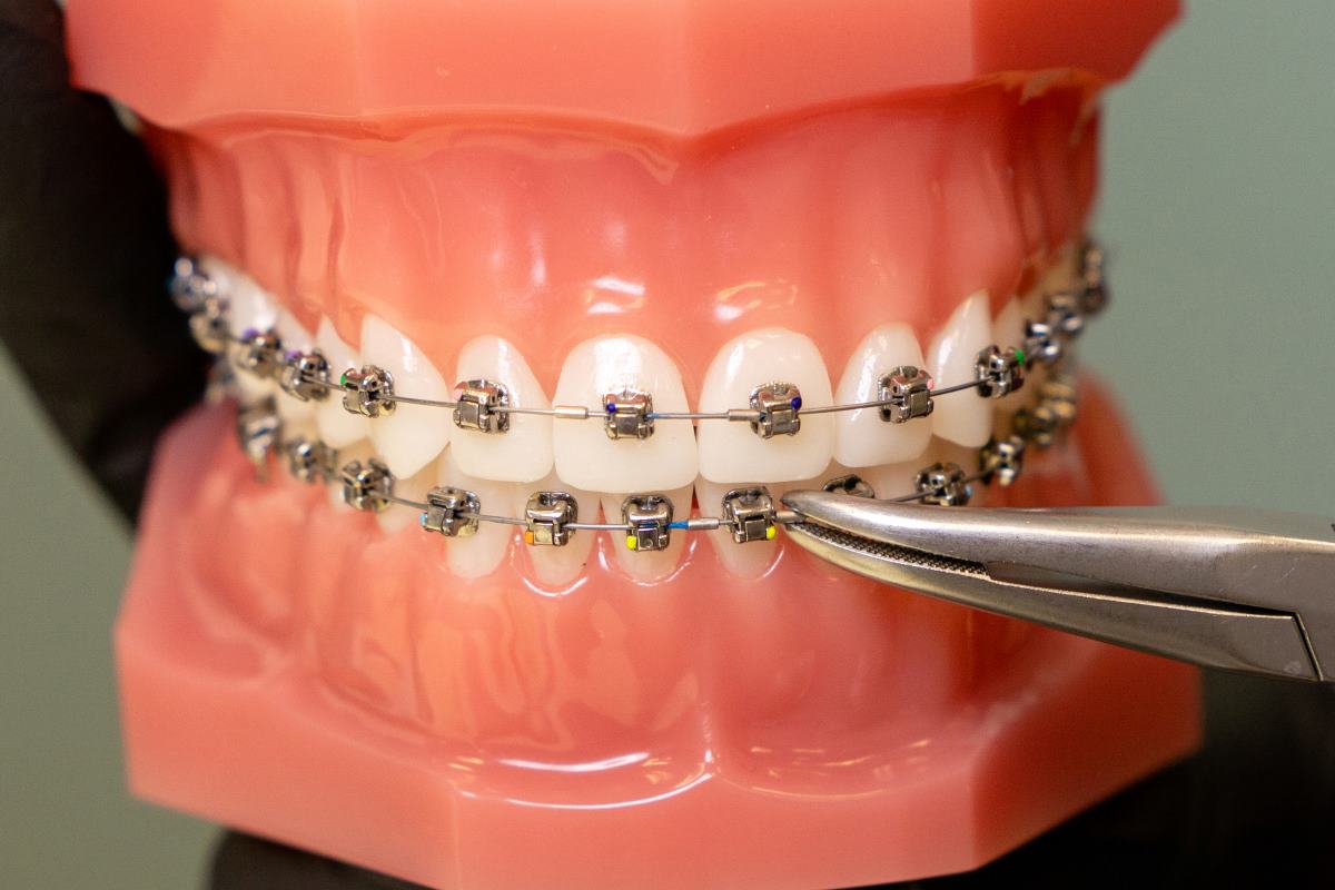 a model of teeth ceramic braces