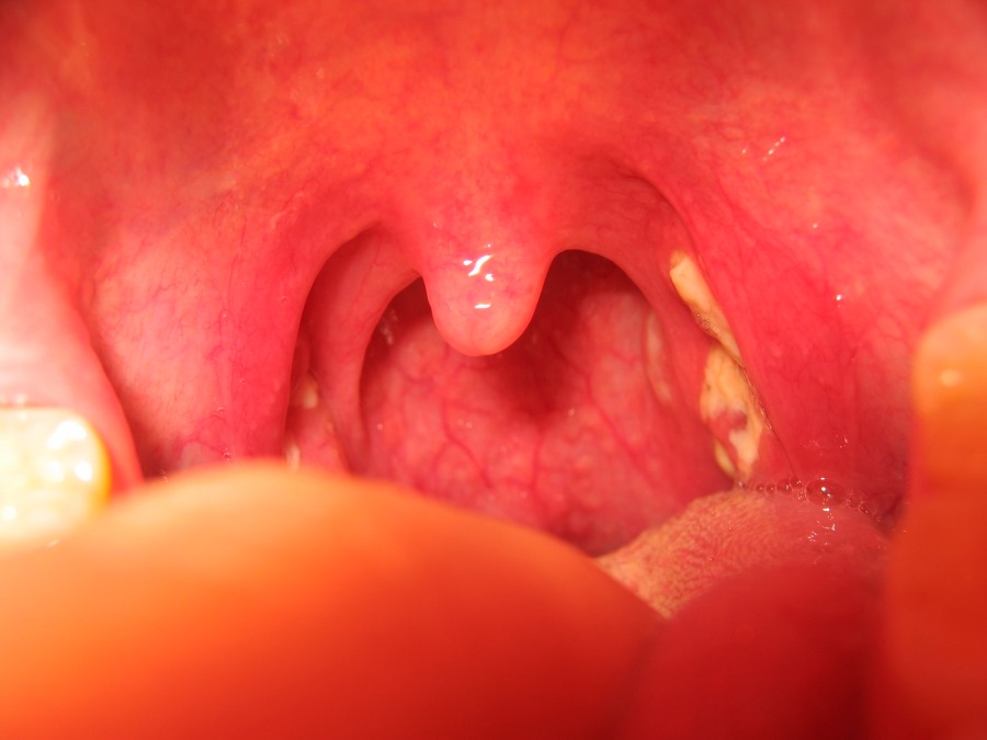 mononucleosis viral throat allergy