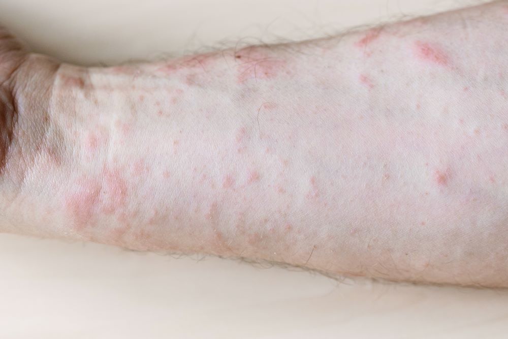 papules-on-inner-side-of-forearm