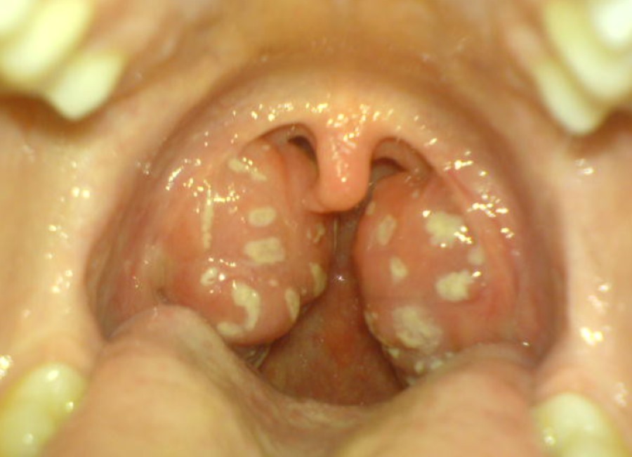 peritonsillar abscess bacterial throat allergy