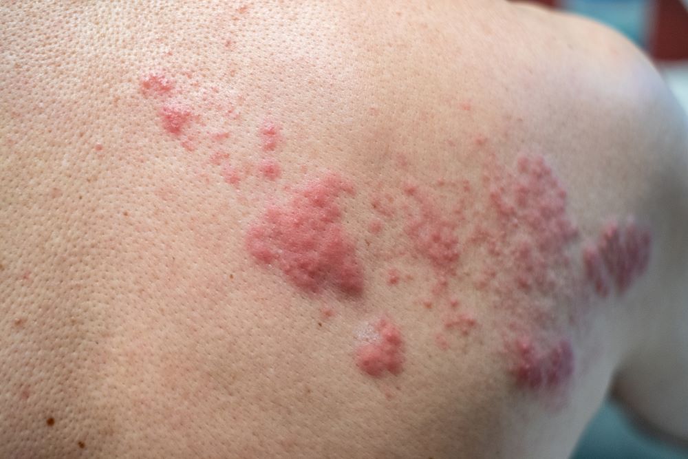 shingles-disease